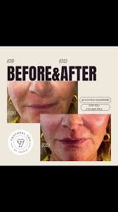 🪄🪄🪄Cheeks and chin MAGIC 🪄🪄🪄, Lift and glow was this client’s wish!,  Abracadabra…🪄, Her wish was granted! ✨, Choosing a professional who  understands your wishes is key to a good outcome. Filler ...