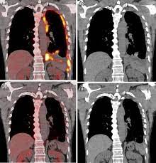 Pet can provide both anatomic and metabolic information, especially in cases of extrathoracic and mediastinal nodal metastasis. Present And Future Roles Of Fdg Pet Ct Imaging In The Management Of Malignant Pleural Mesothelioma Springerlink