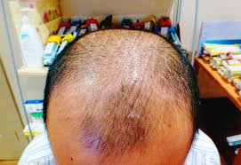 Since you have now understood how helpful acupuncture for hair loss and the entire body, don't you think you should be giving it a try? Case Study Archive Natural Hair Health Acupuncture