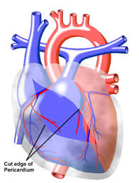 Image result for Pericarditis