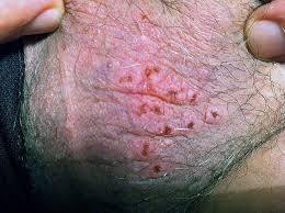 Pictures of herpes reveal a range of symptoms. Herpes Hsv 2 Infection