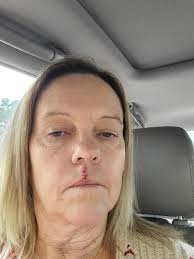 Fundraiser for Stephanie Fields' skin removal surgery