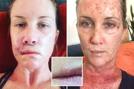 Generally lip (squamous cancer) cancer looks like a dry not likely: Skin Cancer Lump On Sunbed Addict S Lip Turned Out To Be Sign Of Skin Cancer But Op Left Her With Deformed Pout