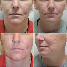 Dr. Jonathan Weiler Discusses Lasers for the Treatment of Acne