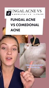 Understanding the Difference: Fungal Acne vs Comedonal Acne
