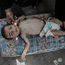 İsrail'in açlığa mahkum ettiği Gazze'de bebekler, süt yerine su ile  besleniyor, ▪️ İsrail’in Gazze’ye yönelik saldırıları nedeniyle 5 aylık  Filistinli bebek Abdülkerim Sobh, ailesiyle birlikte evinden ...