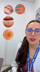 Tratamiento médico para verrugas