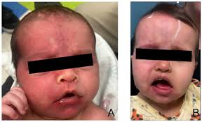 Sturge–Weber Syndrome: A Narrative Review of Clinical Presentation and  Updates