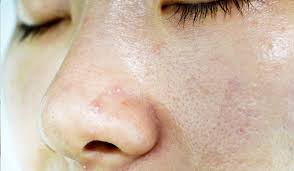 Whiteheads, Milia and Fungal Acne - 7 Dimensions Medical Centre