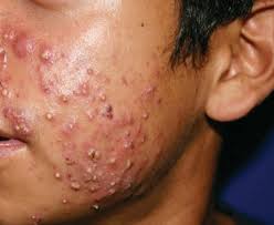 Image result for jerawat