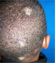 Image result for sores on the head in children