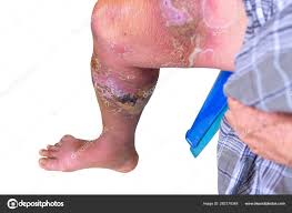 Image result for erysipel photos)