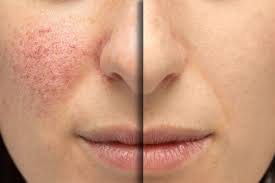 Will Msm Help For Rosacea Rosacea How To Treat Rosacea Rosacea Skin Care