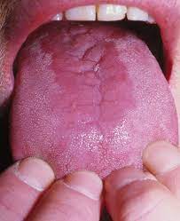 Imidlertid kan det også gi smerter i hoftene. Stomatitt Felleskatalogen