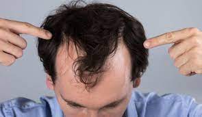 Con l'arrivo dell'autunno è comune osservare una maggior caduta dei capelli; Perdita Dei Capelli Nell Uomo Che Cosa Fare