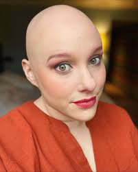 alopecia #representationmatters #mydaytoshine