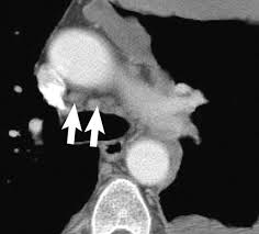 Malignant pleural mesothelioma (mpm) is a rare disease for which there is. Malignant Pleural Mesothelioma Evaluation With Ct Mr Imaging And Pet Radiographics