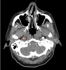 Advertising on our site helps support our mission. Vertebral And Carotid Artery Dissection Wikem