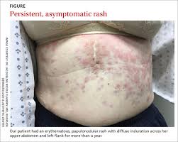 Jun 01, 2021 · ellen a. Persistent Erythematous Papulonodular Rash Mdedge Family Medicine