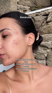 You're wonderful just as you are #acne #foryou