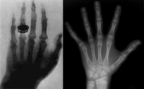 1: (Left) Radiograph of Bertha Roentgen's hand (Right) Modern... | Download Scientific Diagram