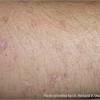 What is nonmelanoma skin cancer? 1