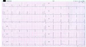 Molto spesso, i disturbi del ritmo l'aritmia sinusale causata da qualsiasi malattia cardiaca richiede il suo trattamento immediato. Una Strana Aritmia Itjem