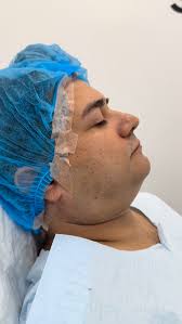 Increible resultado SELFIE PACKAGE con neck lift cerrado con suturas de PDO