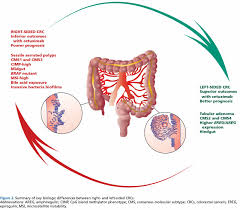 Which one of these methods should be used and. Right Versus Left Colon Cancer Biology Integrating The Consensus Molecular Subtypes In Journal Of The National Comprehensive Cancer Network Volume 15 Issue 3 2017