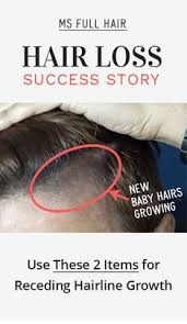 Another great shampoo and conditioner for hair growth are the dermachange hair growth shampoo and conditioner. How To Reverse Receding Hairline At Temples Use This Natural Treatment Hair Loss Remedies Hair Loss Natural Care