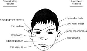 An epicanthic fold, epicanthal fold, or epicanthus is a skin fold of the upper eyelid, covering the inner corner (medial canthus) of the eye. Fetal Alcohol Syndrome Springerlink