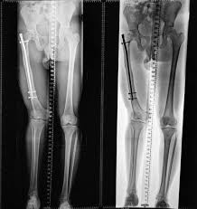 Image result for True Leg Length Discrepancy