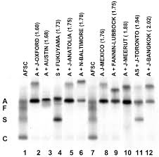 Hplc Retention Time As A Diagnostic Tool For Hemoglobin