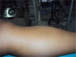 Tibialis Anterior Muscle Hernia A Rare Cause Of Leg Pain
