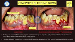 While some cases of gingivitis never progress to. Periodontitis Gingivitis Meaning Symptoms Tx Gum Disease