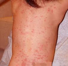 Roseola is a highly contagious viral infection that's most common in children 6 months to 2 years. Roseola Rash Pictures Photos Images Causes Treatment 2020 Updated