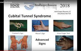 Cubital Tunnel Syndrome Orthopaedicprinciples Com