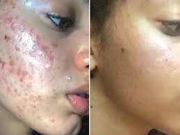 Two skin woes that go hand in hand. This All Natural Acne Skin Care Routine Is Going Viral On Instagram Allure