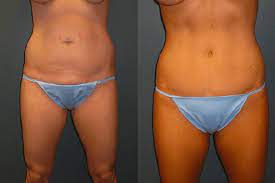 Foods that will cause constipation should be avoided immediately for 1 week after the surgery. Can I Get A Tummy Tuck If I Ve Never Been Pregnant Dr Matthew Conrad
