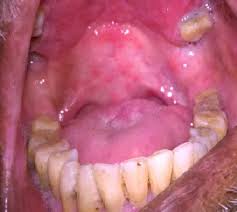 Image result for Erythroplakia roof of mouth