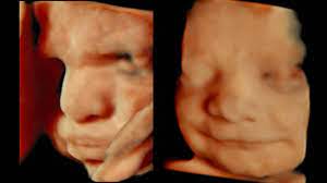 Baby ultraschall venlo, venlo (gemeente) (venlo). 4d Ultraschall Ermoglicht Detailgetreue Abbildung Vom Baby