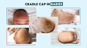 Image result for white scabs on the head in children