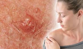 The strongest risk factor for developing skin cancer is ultraviolet (uv) ray exposure, typically from the sun. Skin Cancer Warning Itchy Spot Could Be Sign Other Than A Mole You Need To Watch Out For Express Co Uk