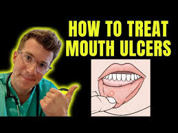 Image result for mouth ulcer on tongue)