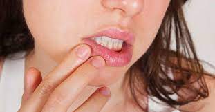 Citrus Allergy Foods To Avoid Symptoms And Treatment