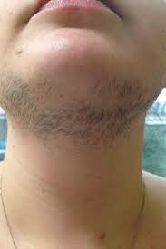 Hirsutism is the excessive growth of thick hair, particularly on areas of the body not commonly seen in women. Unwanted Facial Hair In Reveal Aesthetic S Beauty Facebook