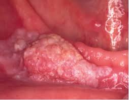 See mouth cancer pictures to learn what common mouth cancer sores on the tongue, gums, and cheek look like. Mouth Cancer Cpd For General Practitioners