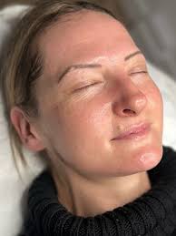 Skin staples: Dermaplaning 🪞 Dermaplaning exfoliates the skin which in  turn removes dead skin cells, vellus hair, excess build up