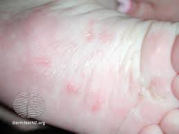 Image result for scabies human bites
