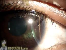 Keratitis is inflammation of the cornea, a clear and transparent covering over the iris and pupil. Hsv Herpetic Dendritic Ulcer On Cornea Video Timroot Com